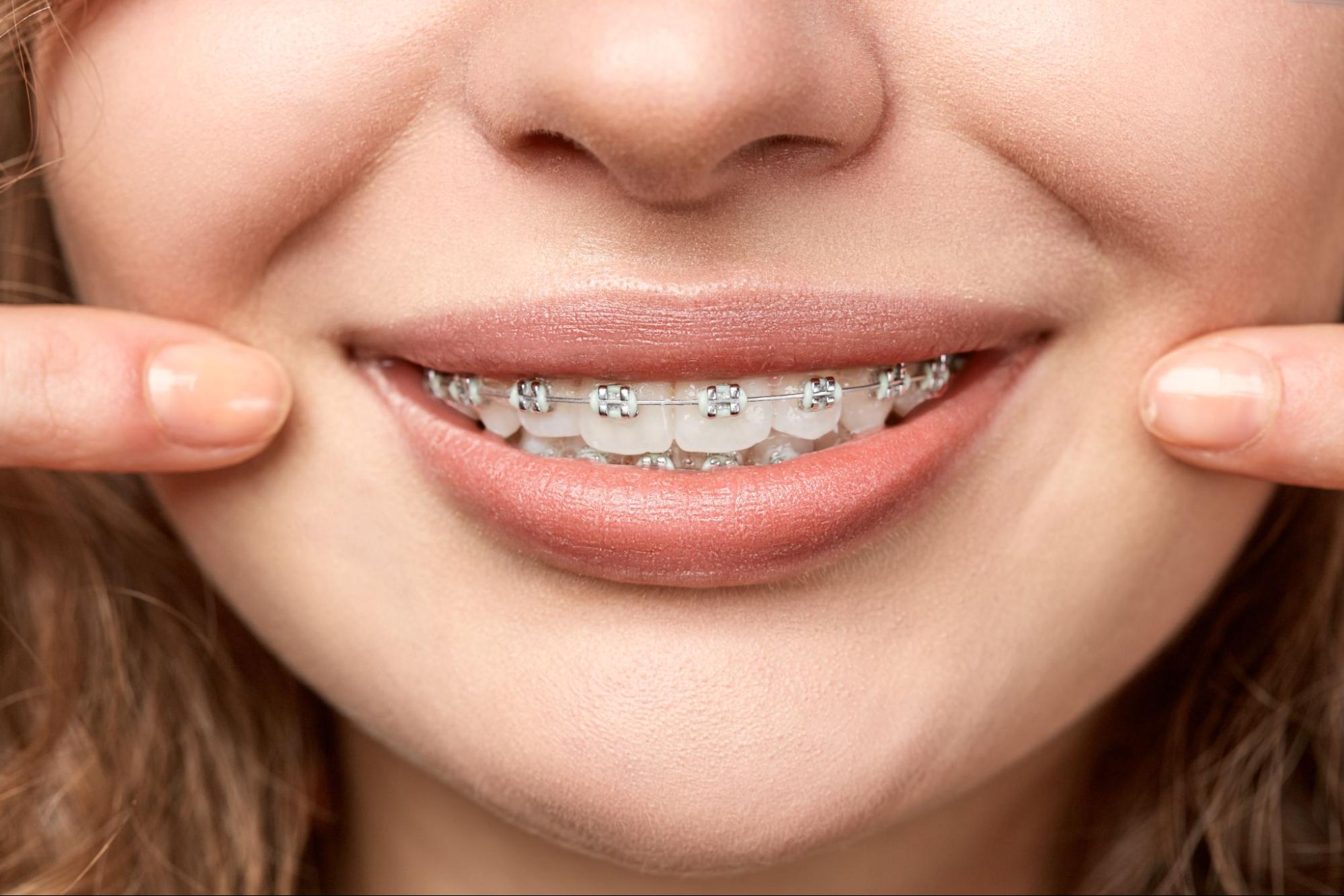Top Tips for Oral Health During Orthodontic Treatment